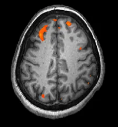 A brain scan shows brain tissue in gray with some small areas in the frontal and occipital lobes highlighted red.